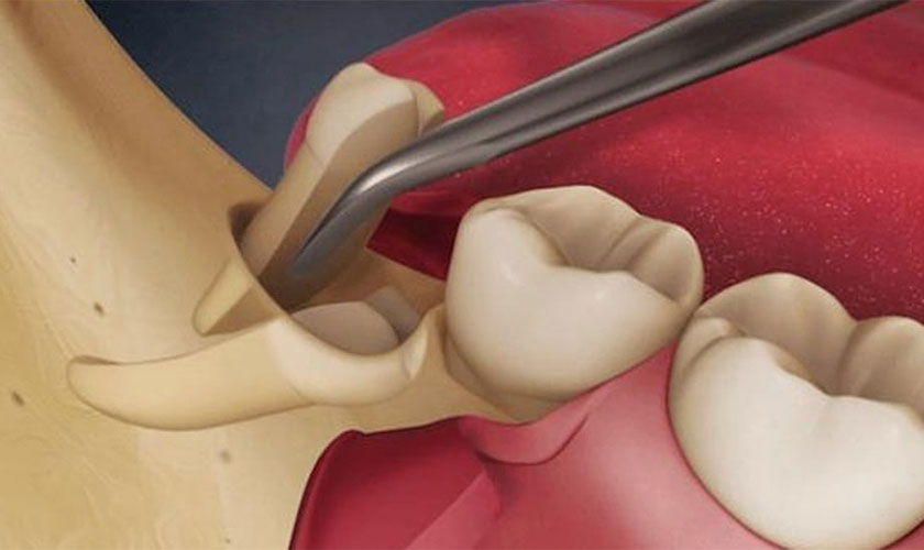 Nhổ răng khôn bao lâu thì lành? Có nhanh không?