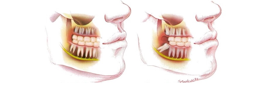 Các dạng mọc của răng khôn