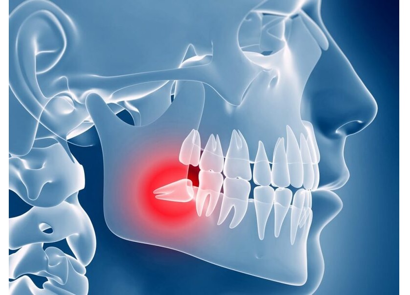 Tiểu phẫu răng khôn khó khăn hay không còn phụ thuộc vào vị trí mọc răng