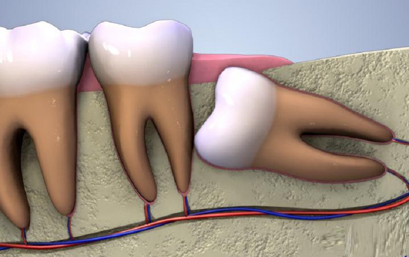 Nguyên nhân răng khôn mọc lệch Nguyên nhân răng khôn mọc lệch