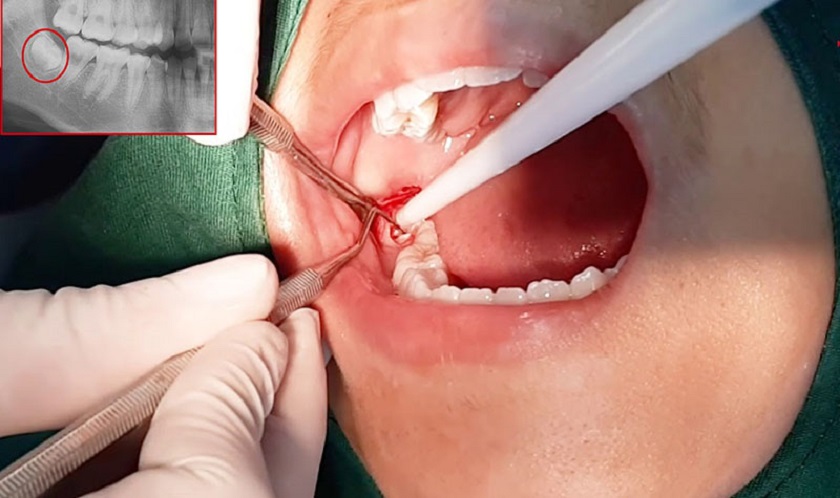 Nhổ răng khôn mọc lệch – có nên không? Nhổ răng khôn mọc lệch – có nên không?