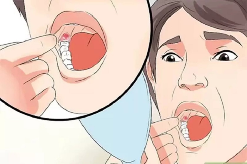 Cần loại bỏ răng khôn khi nào?