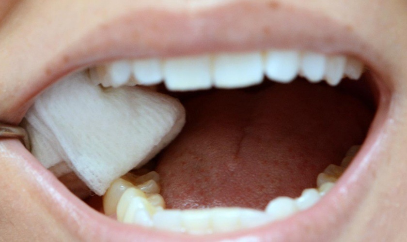 Cắn bông giúp hạn chế chảy máu sau nhổ răng