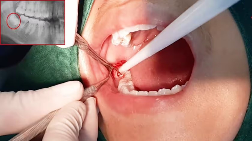 Cần lựa chọn nha khoa nhổ răng khôn uy tín