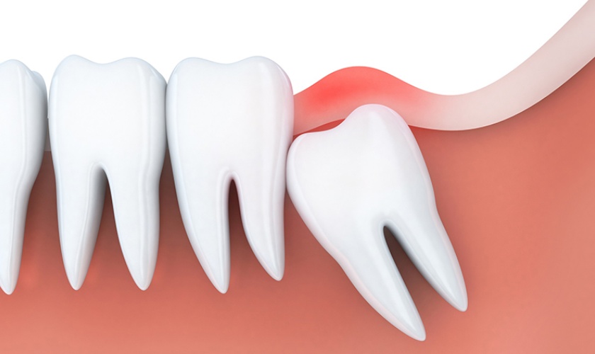 Răng khôn gây sưng đau