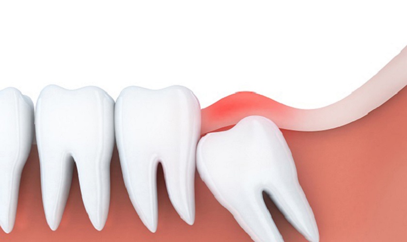 Khi nào cần tiến hành nhổ răng khôn?