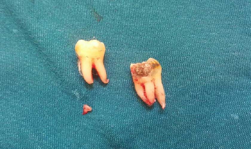 Có nên nhổ 2 răng khôn cùng lúc không?