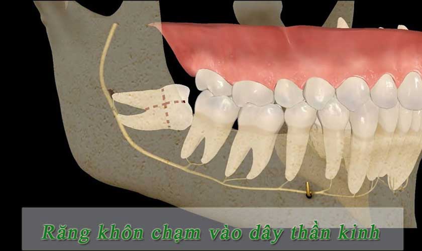 Răng khôn mọc chèn dây thần kinh gây đau vùng hàm - mặt