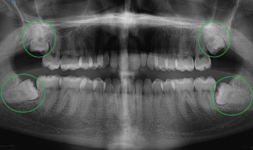 Một người thường có 4 chiếc răng khôn