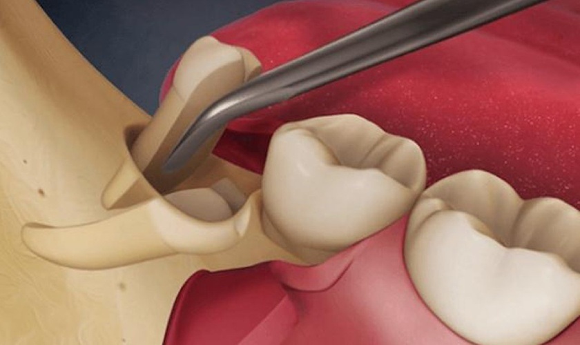 Số lượng răng khôn bị sâu cần nhổ càng nhiều thì chi phí sẽ càng cao