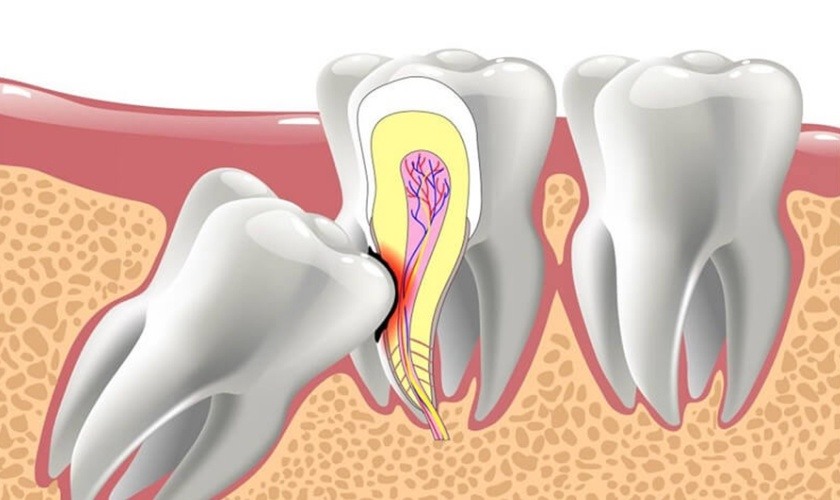 What are the symptoms of wisdom tooth eruption on the lower left side?