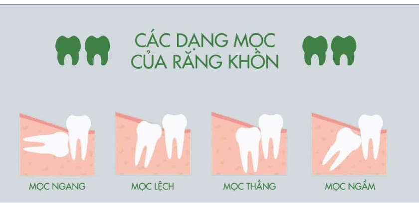 Các dạng mọc của răng khôn