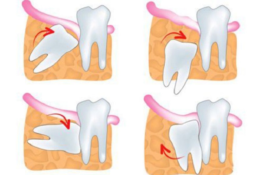 Các dạng mọc của răng khôn