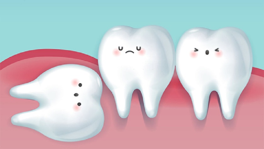 Nên nhổ răng khôn không? Khi nào cần thiết?