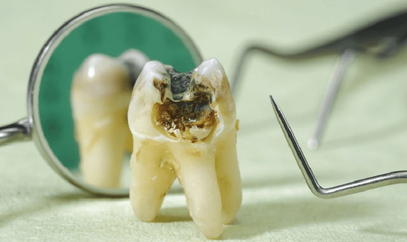 Nguyên nhân răng khôn bị sâu vỡ và cách khắc phục