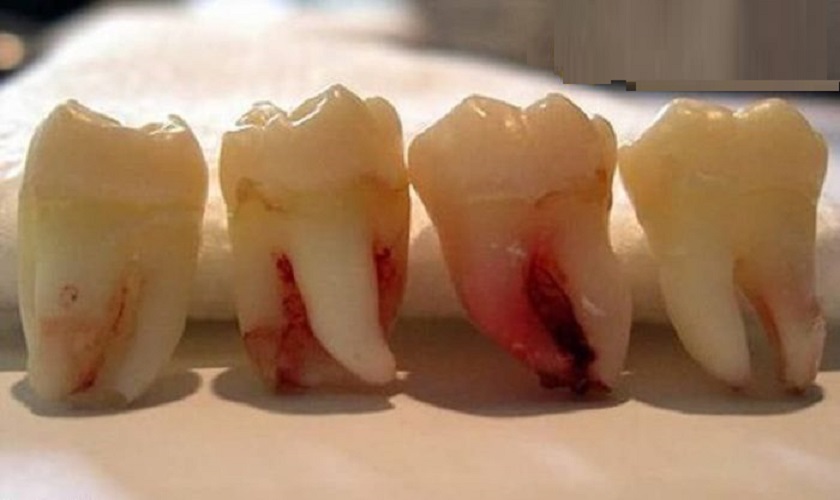 Nhổ 4 răng khôn cùng lúc có được hay không?