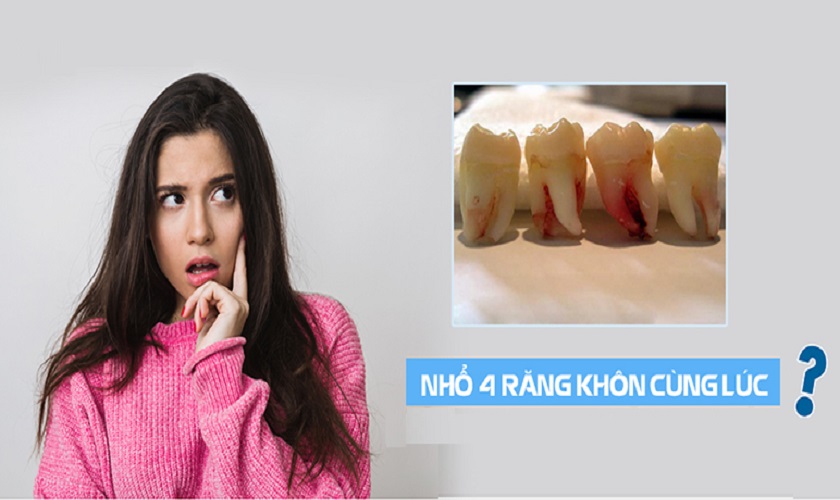 Nhổ 4 răng khôn cùng lúc có được hay không?