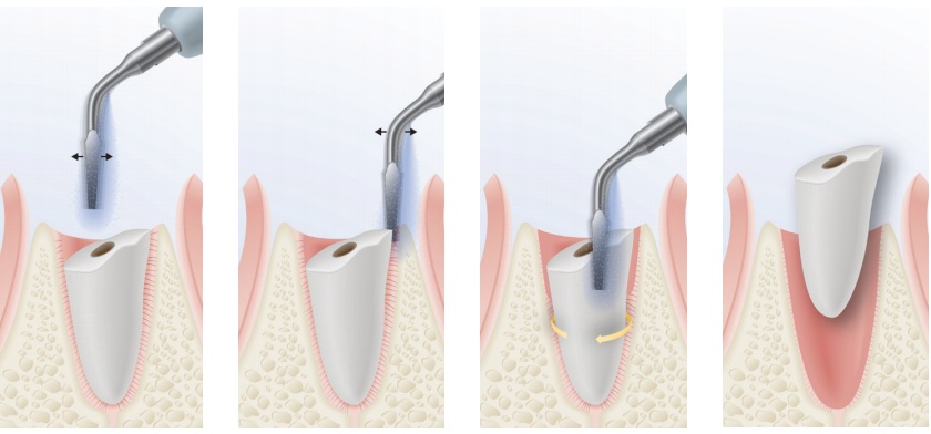 Nhổ răng khôn bằng máy siêu âm Piezotome đảm bảo an toàn