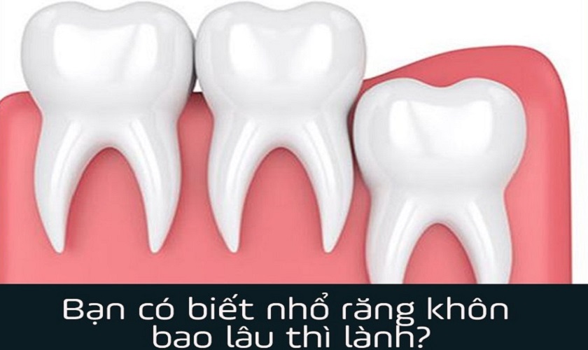 Nhổ răng khôn bao lâu thì lành?