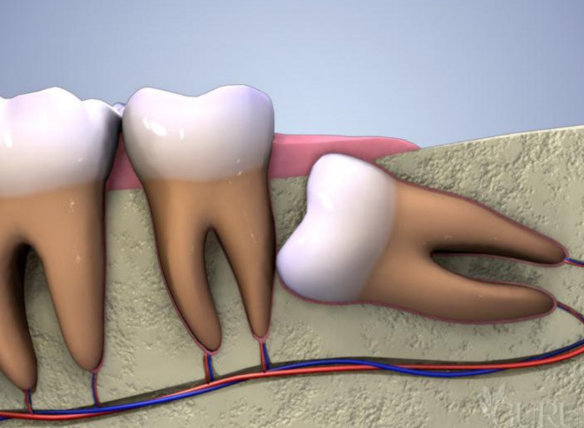 Nhổ răng khôn có ảnh hưởng đến thần kinh hay không?