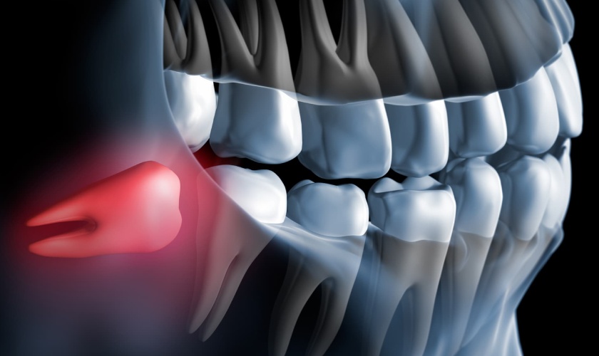 Răng khôn mọc lệch gây nên nhiều biến chứng nguy hiểm