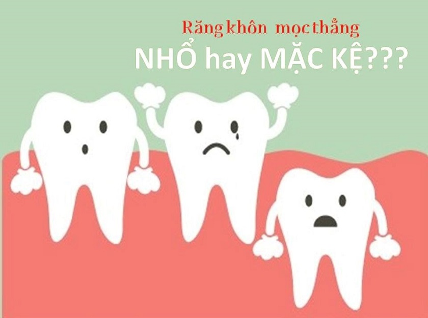 Nhổ răng khôn mọc thẳng có cần thiết không?