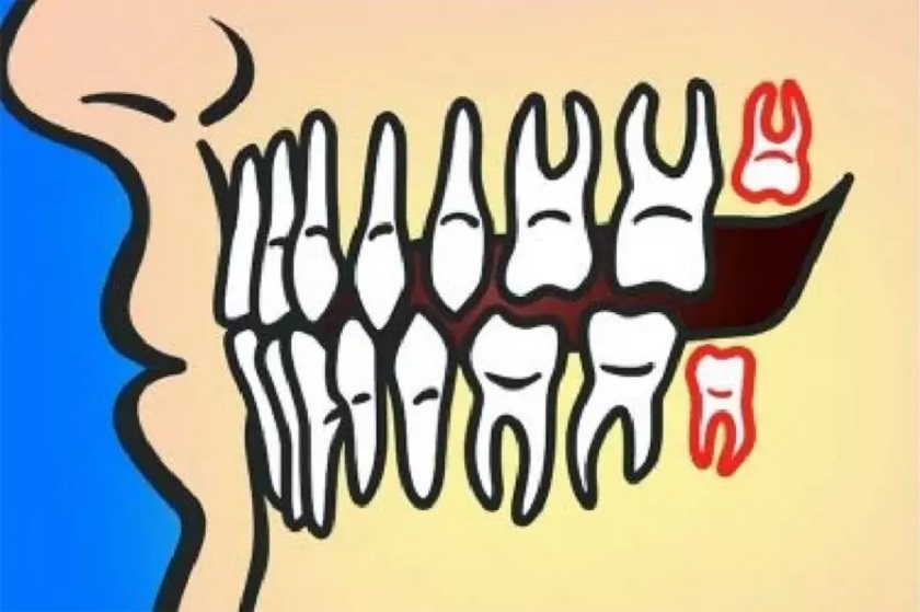 Răng khôn mọc thẳng nhưng không gây bất kỳ tác hại nào thì có thể giữ lại