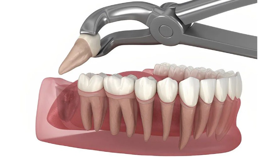 Nhổ răng khôn mọc thẳng khi chúng có kích cỡ bất thường