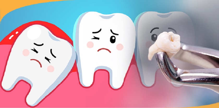 Có nên tiến hành nhổ răng khôn không?