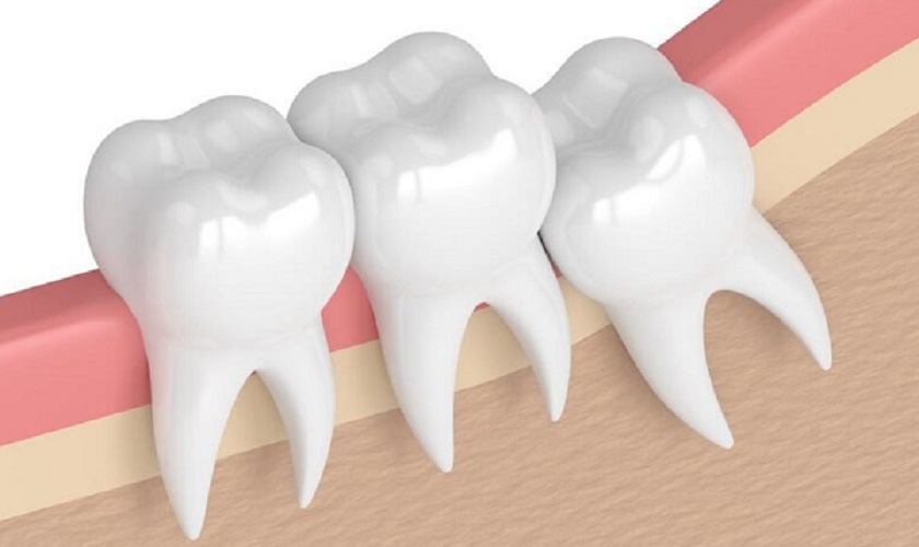 Răng khôn mọc lệch làm tăng nguy cơ sâu răng