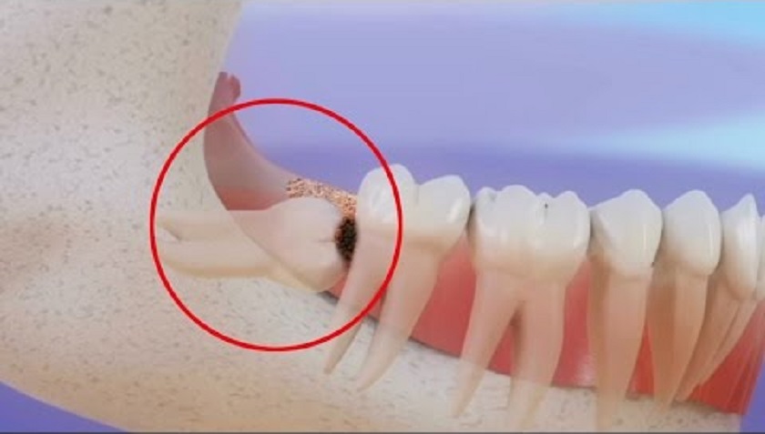 Cần nhổ răng khôn nếu bị sâu hoặc có bệnh nha chu