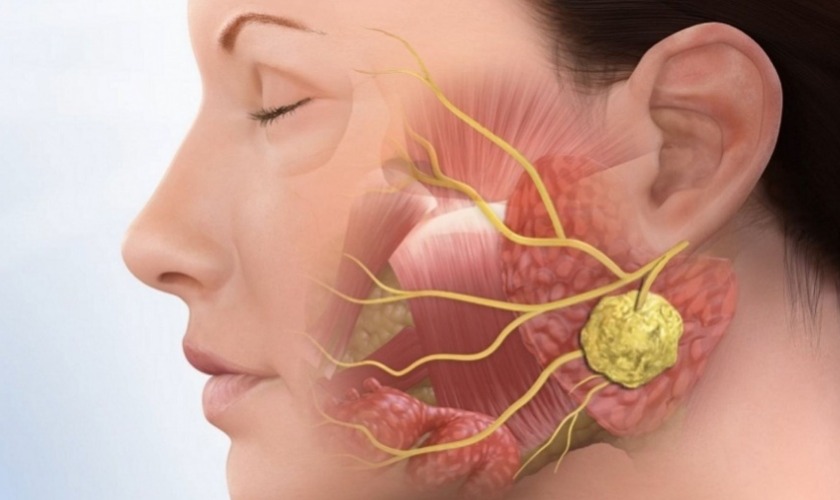 Răng khôn mọc có thể gây ảnh hưởng tới hệ thống thần kinh