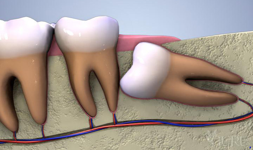Răng khôn mọc ngầm gây nhiều ảnh hưởng đến sức khỏe răng miệng