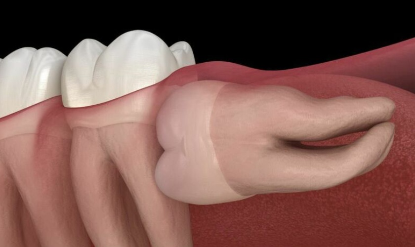 Răng khôn mọc ngầm