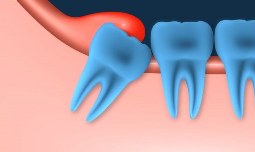 Tìm hiểu về tiểu phẫu răng khôn