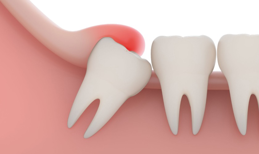 Viêm lợi trùm răng khôn