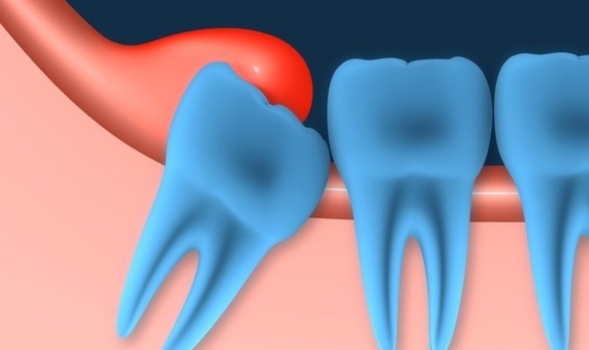 Viêm lợi trùm răng khôn: Dấu hiệu và cách xử lý