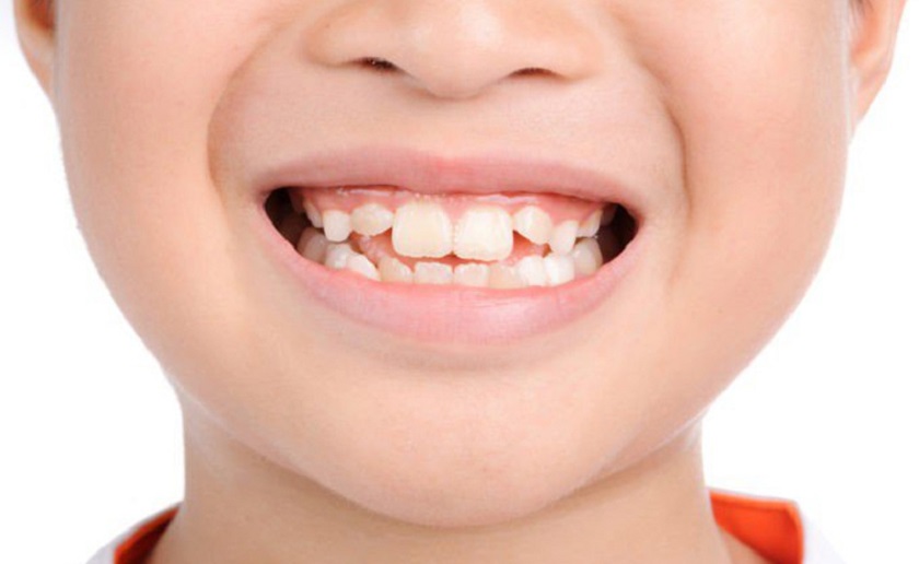 Răng số 5 thông thường sẽ mọc trong độ tuổi 2-3