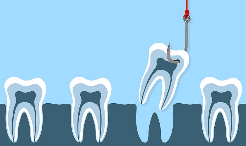 Nhổ răng số 5 hàm trên có nguy hiểm không?