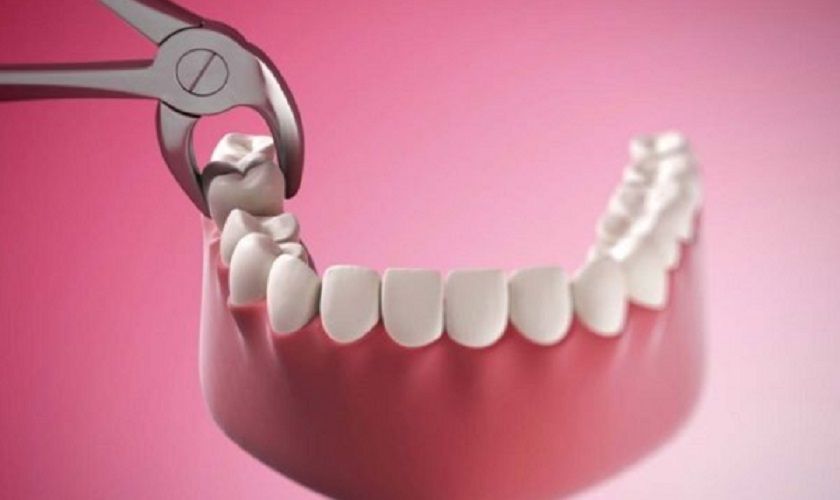 Nhổ răng số 7 có nguy hiểm không? Khi nào cần nhổ?