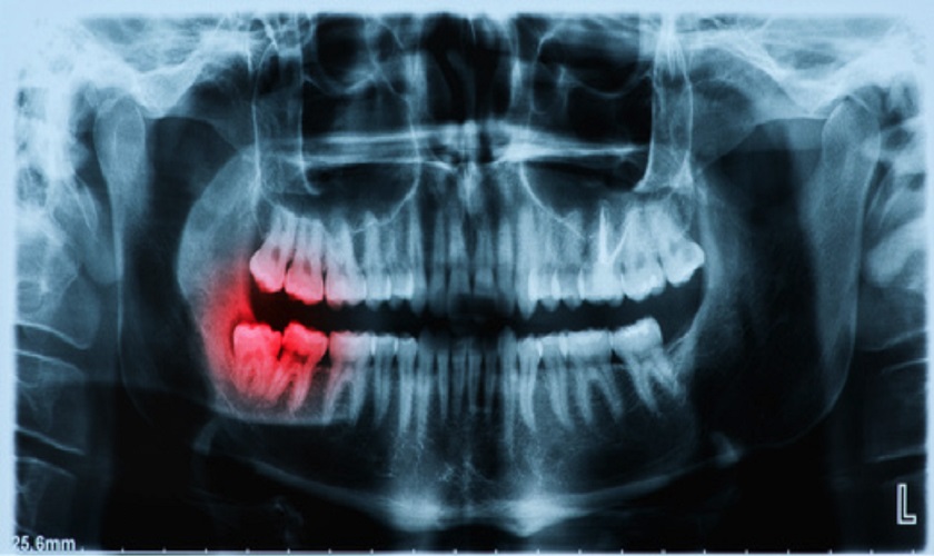 Cần tiến hành chụp X – quang trước khi nhổ răng khôn