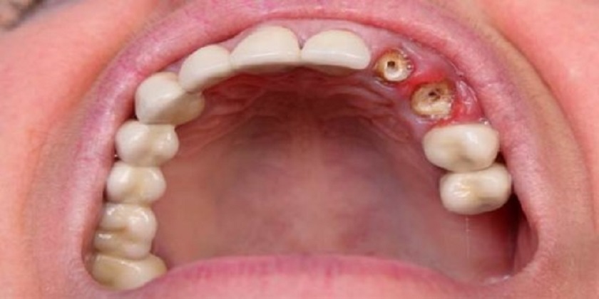 Răng gãy sát với nướu cần nhổ bỏ