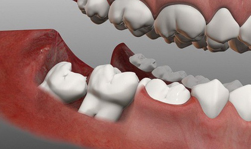 Những dấu hiệu cho thấy răng khôn đã đến lúc phải được nhổ