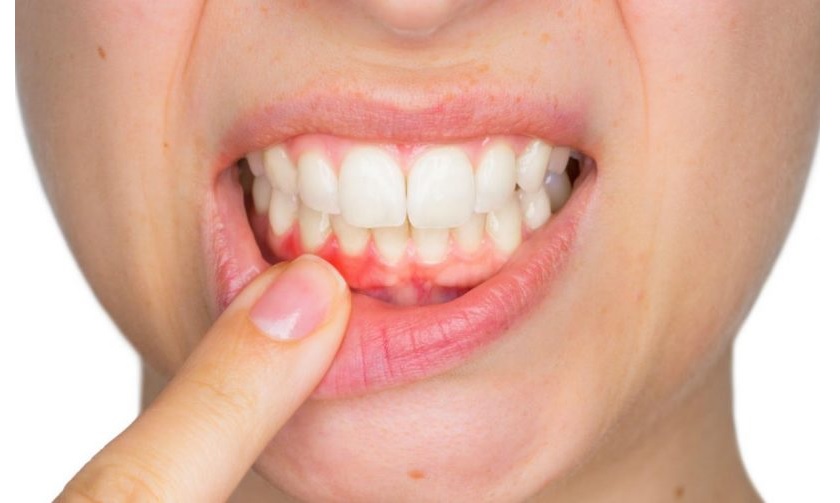 Những biến chứng của răng khôn mọc lệch