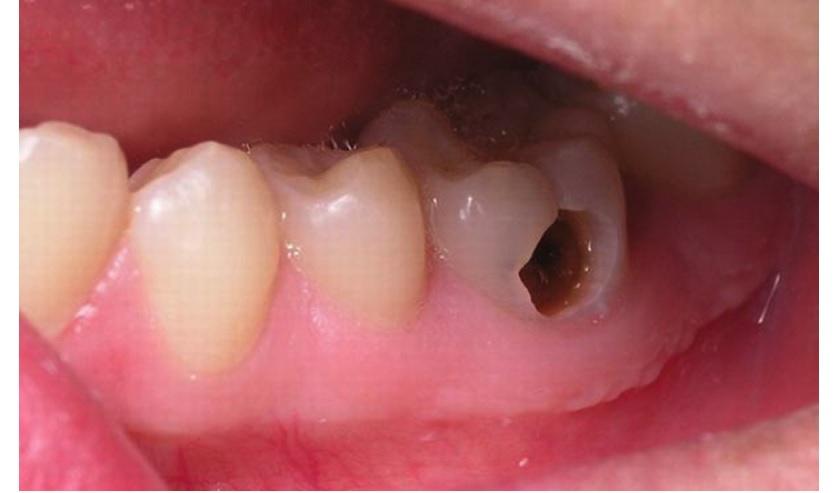 Nhổ răng khôn có gây nguy hiểm cho sức khoẻ không?