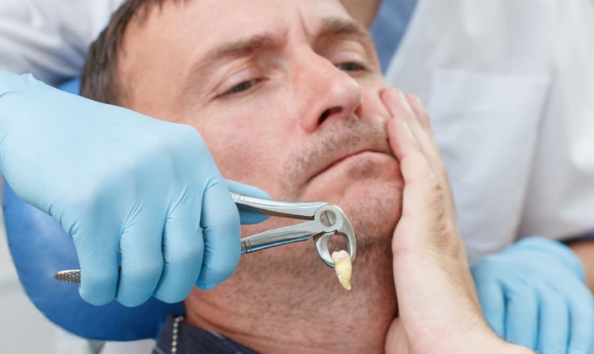 Nhổ răng khôn không đúng cách có thể gây chạm vào dây thần kinh