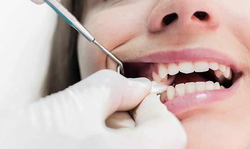 Dùng gạc và giữ chặt miếng gạc ở vị trí nhổ răng trong khoảng 30 - 45 phút để cầm máu