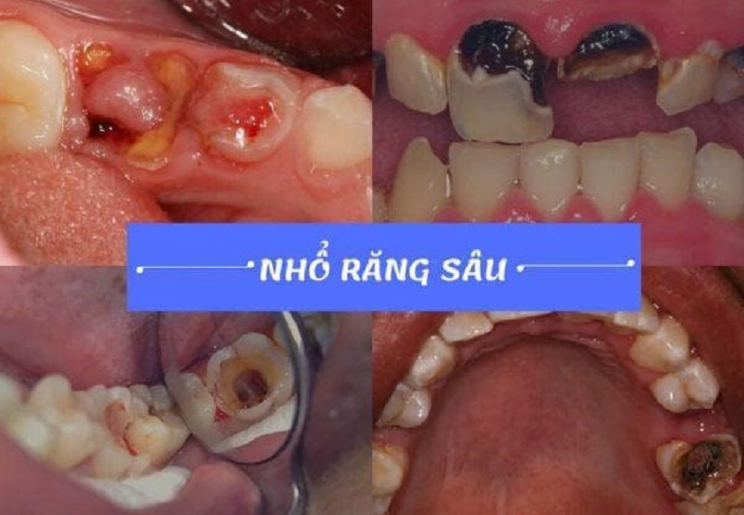 Răng sâu nặng cần nhổ bỏ để tránh ảnh hưởng tới răng bên cạnh