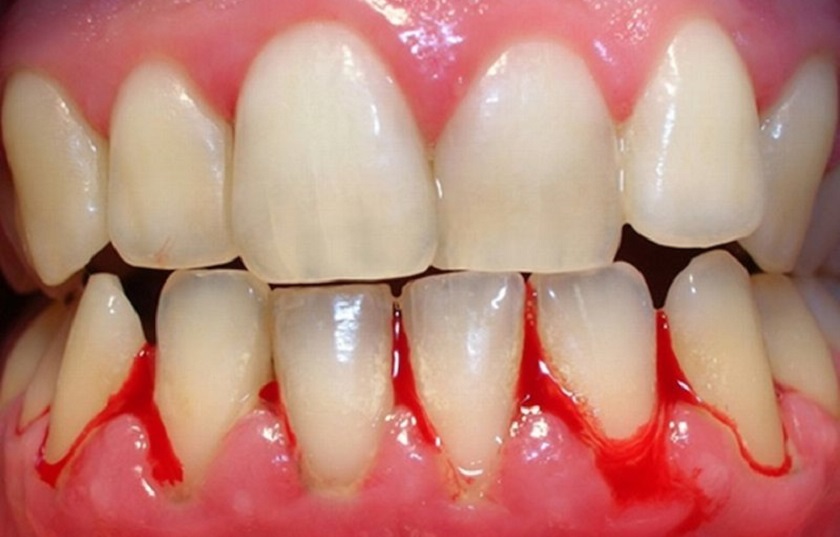 Viêm nha chu nặng có thể là lý do khiến chúng ta phải nhổ răng