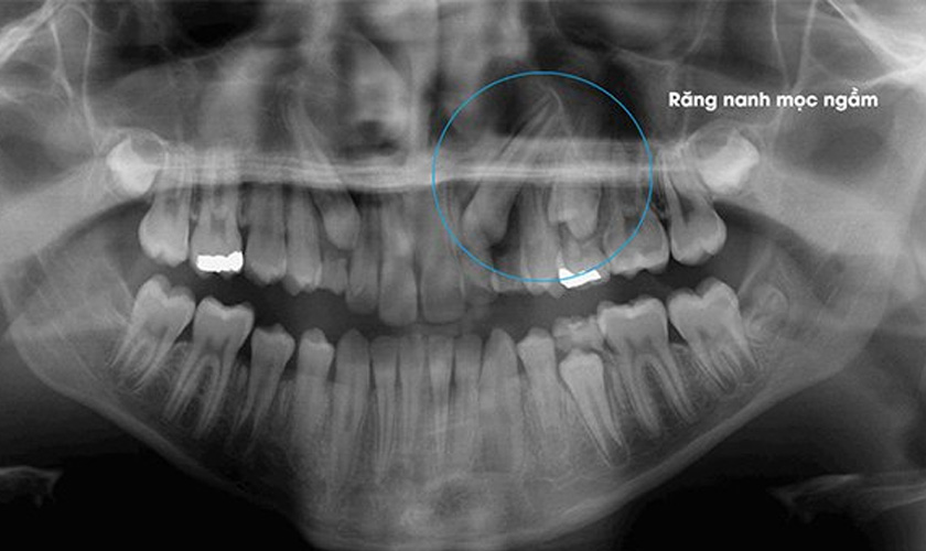 Cách phát hiện và chẩn đoán răng nanh mọc ngầm?
